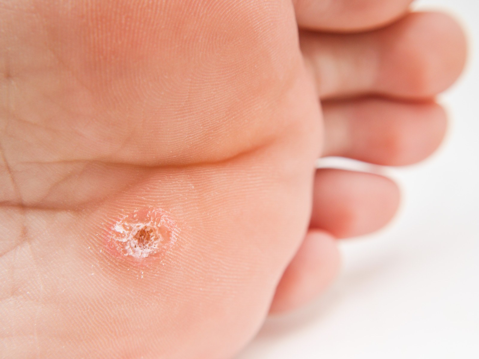 Plantar Warts Commonly Mistaken for 