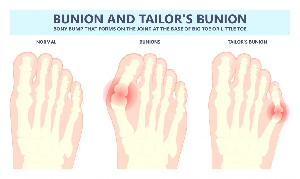 Bunions